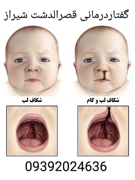 درمان شکاف کام و لب با گفتاردرمانی قصرالدشت شیراز /تغذیه ،شیر دادن ،غذا دادن در شکاف کام