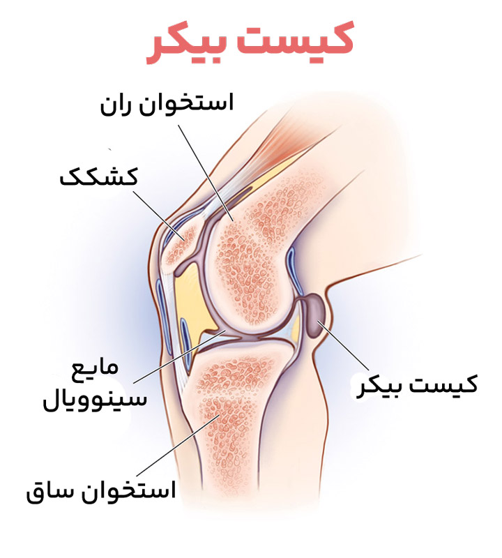درمان توانبخشی کیست بیکر شیراز