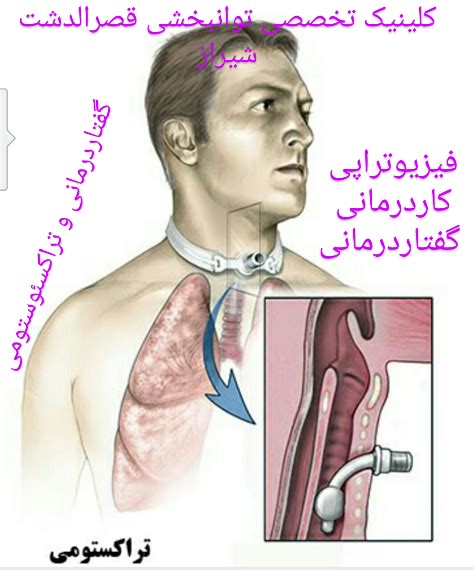 مراقبت از شیرخوار با تراکئوستومی ،گفتاردرمانی در NICU شیراز