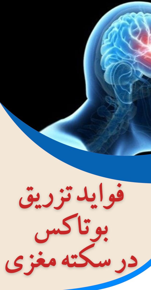 بوتاکس در سکته مغزی شیراز _کاردرمانی و توانبخشی قصردشت شیراز