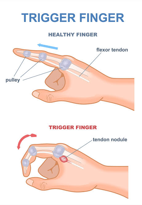 انگشت ماشه ای (تریگر فینگر)از تشخیص تا درمان تخصصی در کاردرمانی،توانبخشی قصردشت شیراز