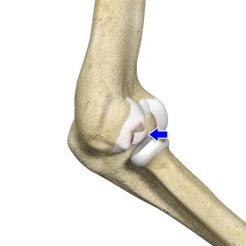 استئوکندریت دیسکان آرنج:تشخیص،درمان و نقش کاردرمانی در بازتوانی _شیراز