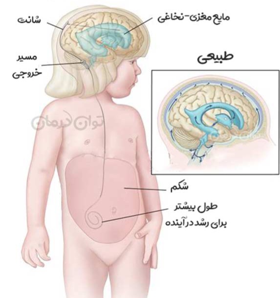 مراقب های پس از شانت گذاری مغزی شیراز